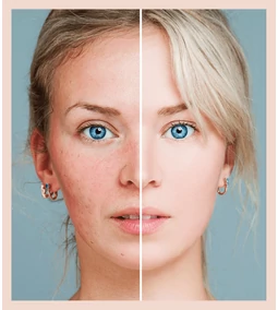 K-beauty rutina za kožu sklonu crvenilu i rozaceji