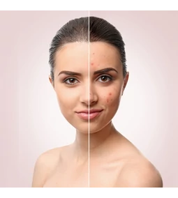 K-beauty hidratantne kreme za kožu sklonu aknama: One zaista djeluju