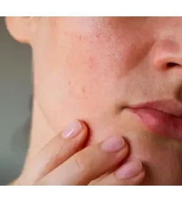 Občutljiva koža? Ti sestavini ji lahko najbolj škodita