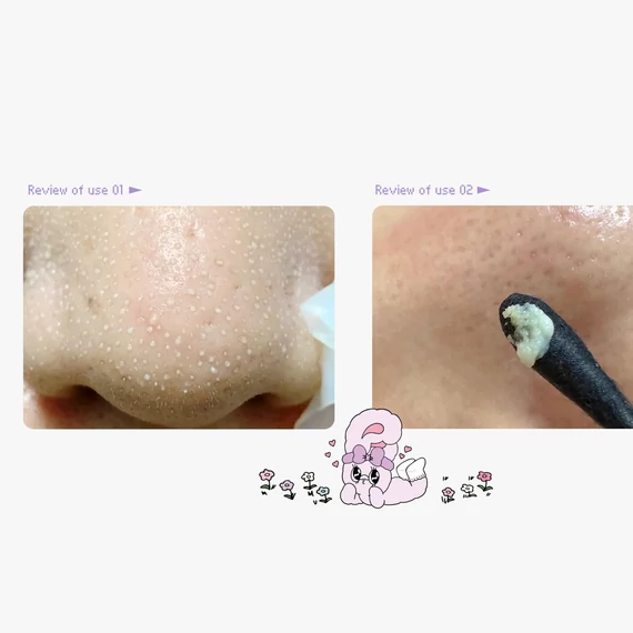 Ilso Super Melting Sebum Softener Set – Sada na Čištění Pórů 150g + 40ks